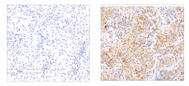 melanoma tumors