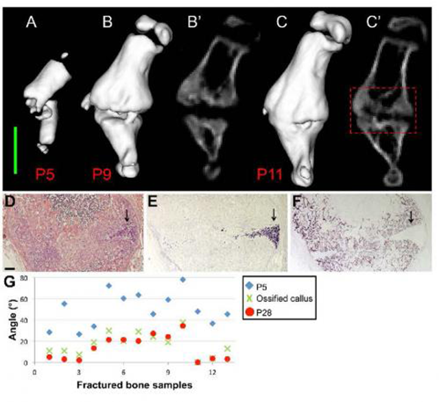 Bone Fractures