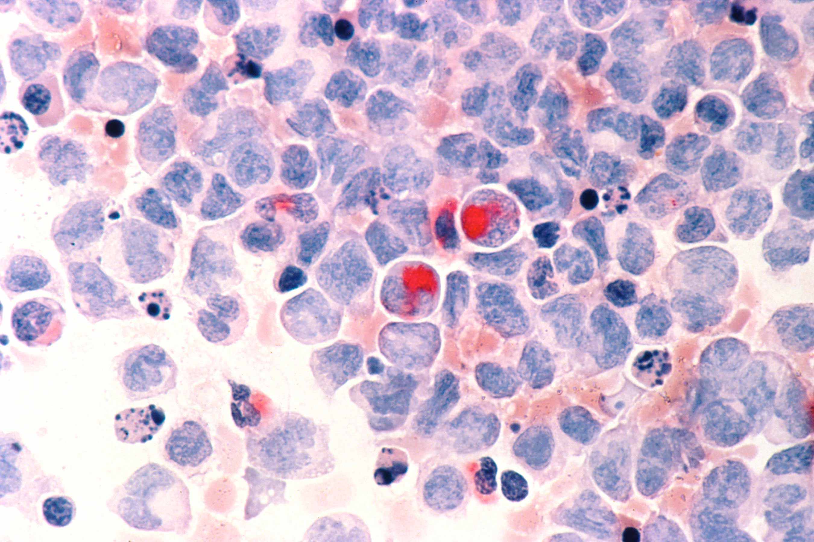 Scientists Can Predict Rare Leukemia 8 Years Before Symptoms Begin