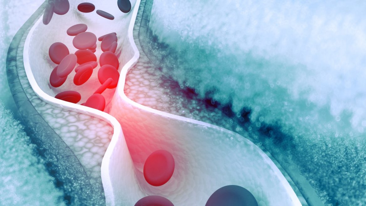 How Does a Helpful Substance Like Cholesterol Turn Deadly?